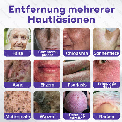Dobshow® Mikronadelpflaster gegen Warzen und Muttermale