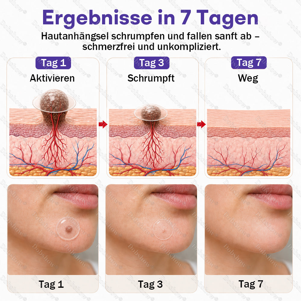 Dobshow® Mikronadelpflaster gegen Warzen und Muttermale