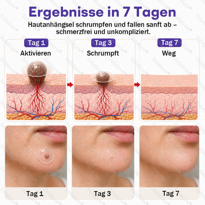 Dobshow® Mikronadelpflaster gegen Warzen und Muttermale